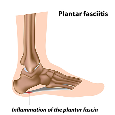 Is my heel pain from plantar fasciitis? | Gundersen Health