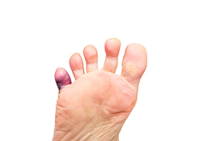 A Successful Treatment Method for a Broken Toe