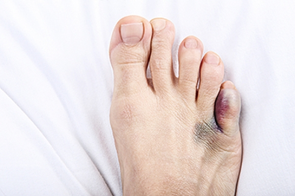 Sore on pinky toe from shoes discount