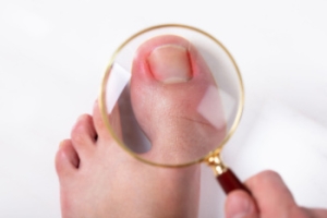 Managing a Stubborn Ingrown Toenail