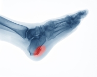 Common Myths About  Heel Spurs